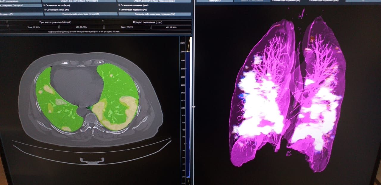 НТЦ «Модуль» разработал программное обеспечение для диагностики пневмонии
